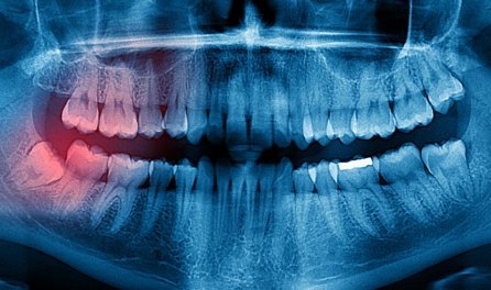 Dental X Ray Showing A Impacted Wisdom Tooth